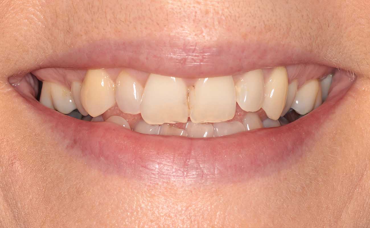 Treatment Before Image Reading | Aspire Clinic